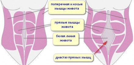 Диастаз мышц живота